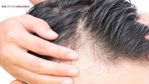 In oltre indicheremo i rimedi più efficaci per contrastare la caduta. Centro Tricologico Istituto Giglio Caduta Capelli Cosa Succede Dopo I 40 Anni