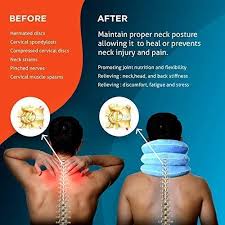 Spinal fusion is a surgical procedure that links bones in the spinal column together to treat back problems such as herniated disks, fractures, or scoliosis. Cervical Neck Traction Device By Neckfix For Instant Neck Pain Relief Adjustable Neck Stretcher Collar For Home Traction Spine Alignment Model 2019 Bonus 12 17 Inch Pricepulse