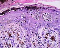 What does lentigo maligna melanoma look like? Acral Lentiginous Melanoma Wikipedia