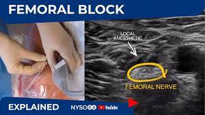 Ultrasound Guided Femoral Nerve Block Nysora