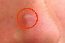 Wenn sie doch selbst hand anlegen möchten, sollten sie. Pickel Soll Man Nicht Ausdrucken Aber Ich Sage Dir Mach Es Doch Und Zwar So Pickel Behandeln Haut Tipps Mitesser