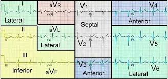 12 Lead Ekg Interpretation Ekg Interpretation Icu Nursing Ekg Nursing