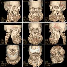 Cherubism is a rare genetic disorder of the jaw characterized by bilateral, symmetrical enlargement of the mandible and/or maxilla resulting from rapid bone degradation followed by extensive bone. Aggressive Case Of Postpubertal Cherubism A Case Report
