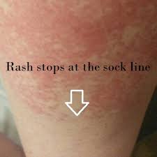 Additionally, this remedy is easy to make and very inexpensive. The Disney Rash Description Prevention And Treatment Build A Better Mouse Trip
