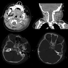 Image result for Mastoiditis