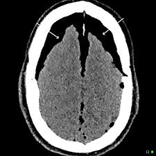 Mount Fuji Sign Is Seen On Cross Sectional Imaging And Implies Tension Pneumocephalus Is Present The Sign Refers To Th Radiology Medical Imaging Radiography