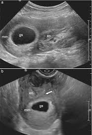Image result for First Trimester Ultrasound