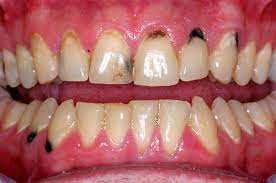 Black Spots On Gums Near Tooth Nha Khoa Quạ Khỏe Mạnh