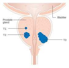Pin On Natural Remedy For Prostate