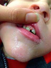 Dental Issues Of Prematurity Hand To Hold