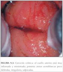 Tratamiento maternity excitación cervicales inflamados. La Colposcopia Y El Tratamiento De La Neoplasia Intraepitelial Cervical Manual Para Principiantes