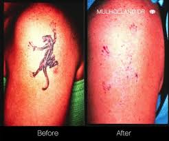 When i looked up creams for getting rid of. Picoway Laser Tattoo Removal In Toronto Spamedica