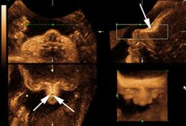Genetic Sonography 3d Us