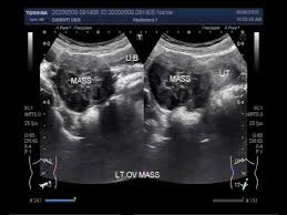Ct scans can provide images of the abdominal cavity and pelvis, and they can show whether any unusual growth is present. Ultrasound Video Showing An Ovarian Tumor Youtube