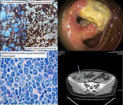 In cases where cancer cannot be prevented, colonoscopy helps to. A Diffuse Large B Cell Lymphoma Detected During Colorectal Cancer Screening Colonoscopy Digestive And Liver Disease
