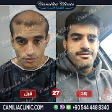 pin by mesfr on الشعر in 2021 hair transplant hair transplant results best hair transplant