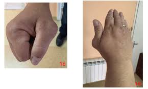 The body takes a large accumulation of salts for a foreign body. Chronic Tophaceous Gout Unique Presentation In A Bulgarian Patient