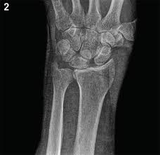 Image result for Scapholunate Dislocation