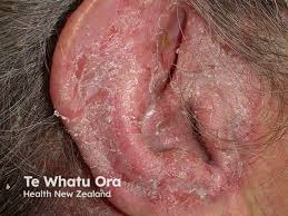 Image result for Acute Otitis Externa