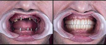 One in five people with learning disabilities in scotland aged 35 to 44 years has no teeth, a study has revealed.people with such disabilities are ten times more likely than other people of the same. I Have No Teeth What Are My Options Smile Angels Of Beverly Hills