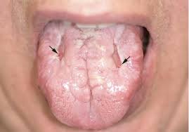 Image result for Fissured tongue