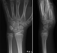 Image result for Wrist XRay