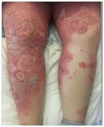 Image result for Pustular Psoriasis