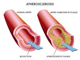 More news for how to know if you have blocked arteries » Recognize Atherosclerosis Symptoms That Indicate Heart Disease University Health News