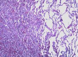 Any condition that makes it difficult to swallow 3. Post Operative Atelectasis Risk Factors Management Teachmesurgery