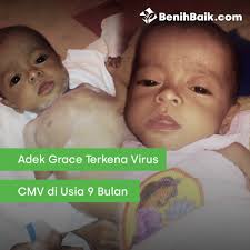 Adek Grace Terkena Virus CMV di Usia 9 Bulan