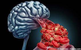 Schlaganfall Symptome Diagnostik Therapie Gelbe Liste