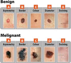 Abcde Chart For Diagnosis Of Cancerous Mole Skin Moles