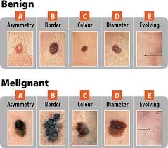 abcde chart for diagnosis of cancerous mole skin moles