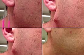 Using a dull razor means you have to apply more pressure, which is more likely to lead to cuts and irritation. Is This The Longest Ingrown Hair In History Man Films Himself Removing Pus Covered Black Strand Mirror Online