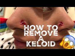 How I Removed My Nose Piercing Bump Keloid Youtube Nose Piercing Bump Piercing Bump Nose Piercing