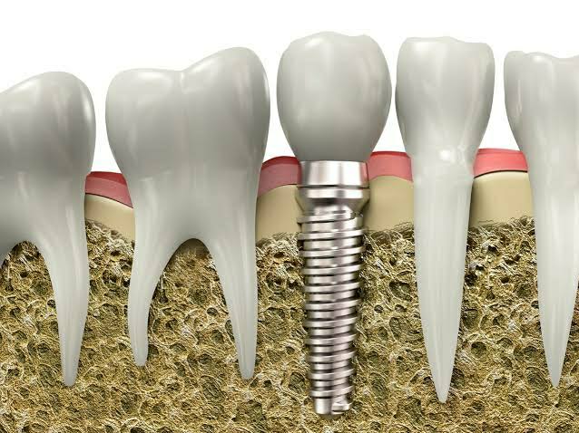 Dental Implant product image