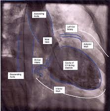 Image result for Nuclear Ventriculogram