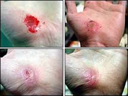 Larger, deeper wounds may take 2 weeks or longer for the wound to heal completely and the scab to disappear. Moist Wound Healing Versus Dry Wound Healing Wound Treatments Woundsource