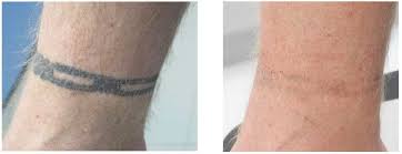 Tattoo removal takes multiple treatment sessions and costs on average about $450 per session. Tattoo Removal Cost Schweiger Dermatology Group
