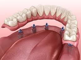 Autumn care of nash 1210 eastern avenue, nashville, nc 27856 4.7 miles away. Dentures Rocky Mount Nc Missing Teeth Dental Implants