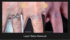 At seattle plastic surgery, we happily offer laser tattoo removal to the seattle and tacoma areas. Laser Tattoo Removal Gallery Nazarian Plastic Surgery