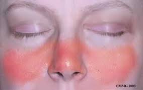 يعتبر مرض الذئبة الحمراء واحد من الأمراض المناعية والذي يحدث عندما تقوم المناعة بمهاجمة الأعضاء والخلايا، تعرف من المقال على أسباب وأعراض الذئبة الحمراء. Ø§ÙØ°Ø¦Ø¨Ø© Ø§ÙØ­ÙØ±Ø§Ø¡ Ø§ÙØ¬ÙØ§Ø²ÙØ© Ø§ÙØ°Ø¦Ø¨Ø© Ø§ÙØ­ÙØ§ÙÙØ© Ø·Ø¨ÙØ¨ Ø¯ÙØª ÙÙÙ