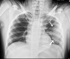 Image result for Pulmonary Contusion