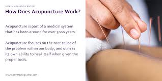 Image result for Acupuncture