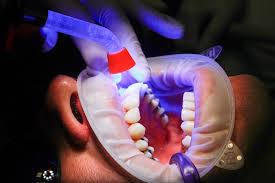 It is adviced to meet your dentist regularly as the oral cavity is the gateway to nutrition which gives health. Apex Dental Clinic Chembur Best Dentist Near Me