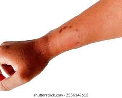 Image result for Human Bite