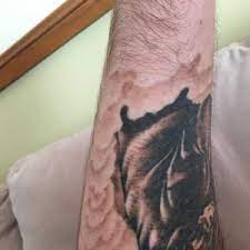 When that runs out, you can use regular cotton pads and 70% isopropyl alcohol. Hyperpigmentation After Tattoo Removal How Can I Treat This Photos
