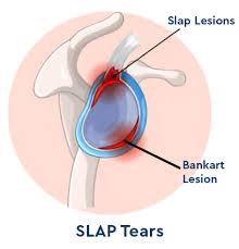 Image result for SLAP Lesion