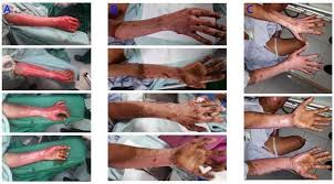 Entry into a hospital is usually called an admission. A The First Day Patient Was Admitted To The Hospital Burns Were Seen Download Scientific Diagram