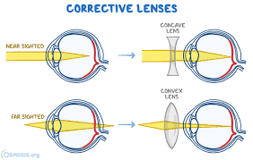 Image result for Refractive Error